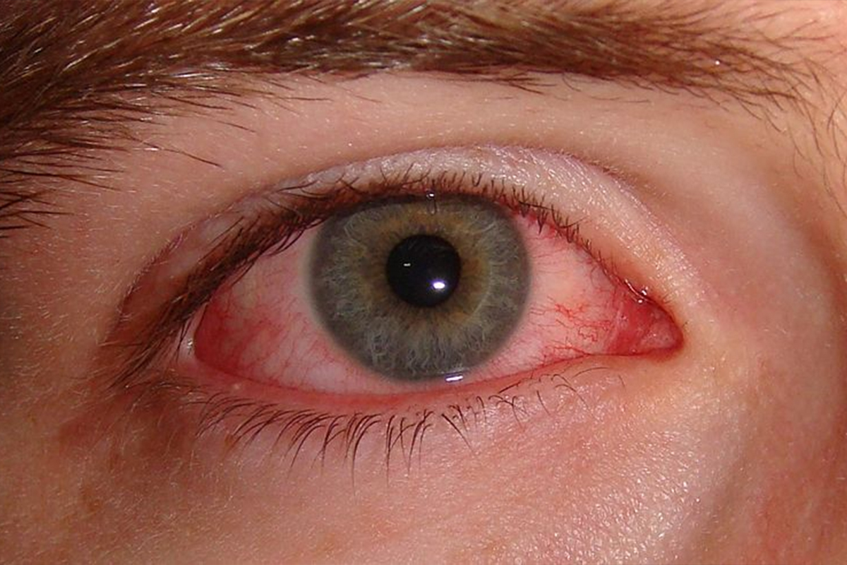 sjogren-syndrome-eye